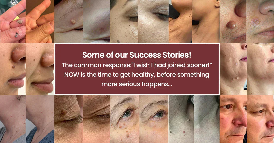 ✨Limited-Time Sale Ends Soon | Lumivo® 2-in-1 Microneedle Hydrocolloid Patches for Moles, Acne, Warts & Skin Tags