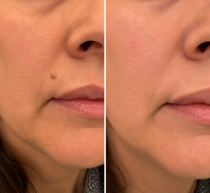 ✨Limited-Time Sale Ends Soon | Lumivo® 2-in-1 Microneedle Hydrocolloid Patches for Moles, Acne, Warts & Skin Tags